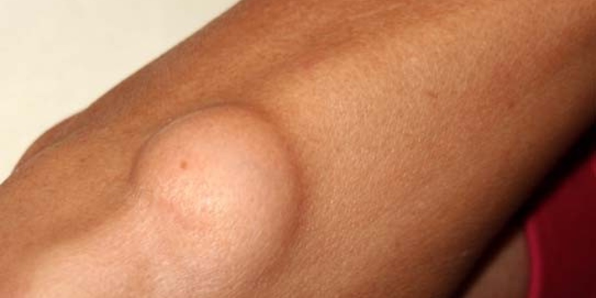 Lipoma Treatment in Islamabad: When Should You See a Doctor?