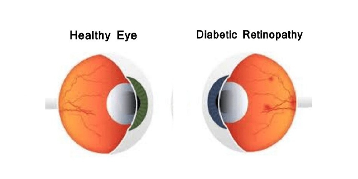 Diabetic Retinopathy Market Size & Forecast