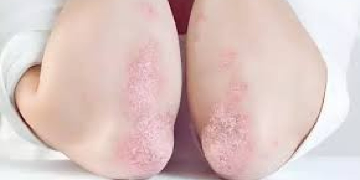 Secukinumab Market Forecast by Application 2034