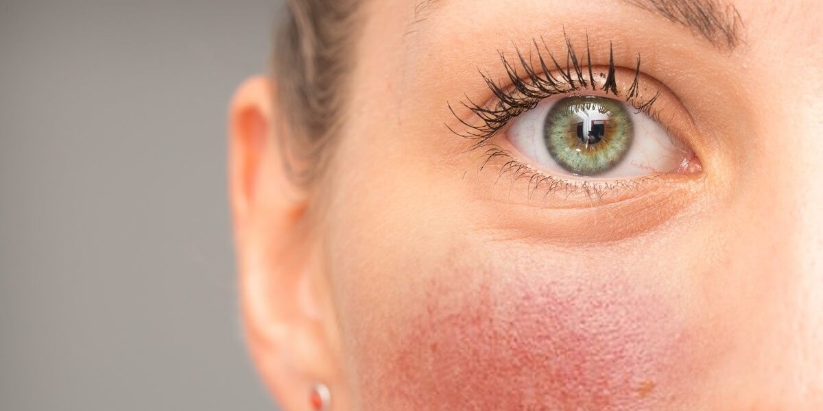 What Triggers Are Managed in a Rosacea Treatment Plan?