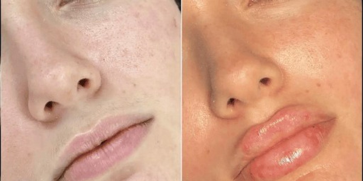 Non-Surgical Makeovers with Fillers in Dubai