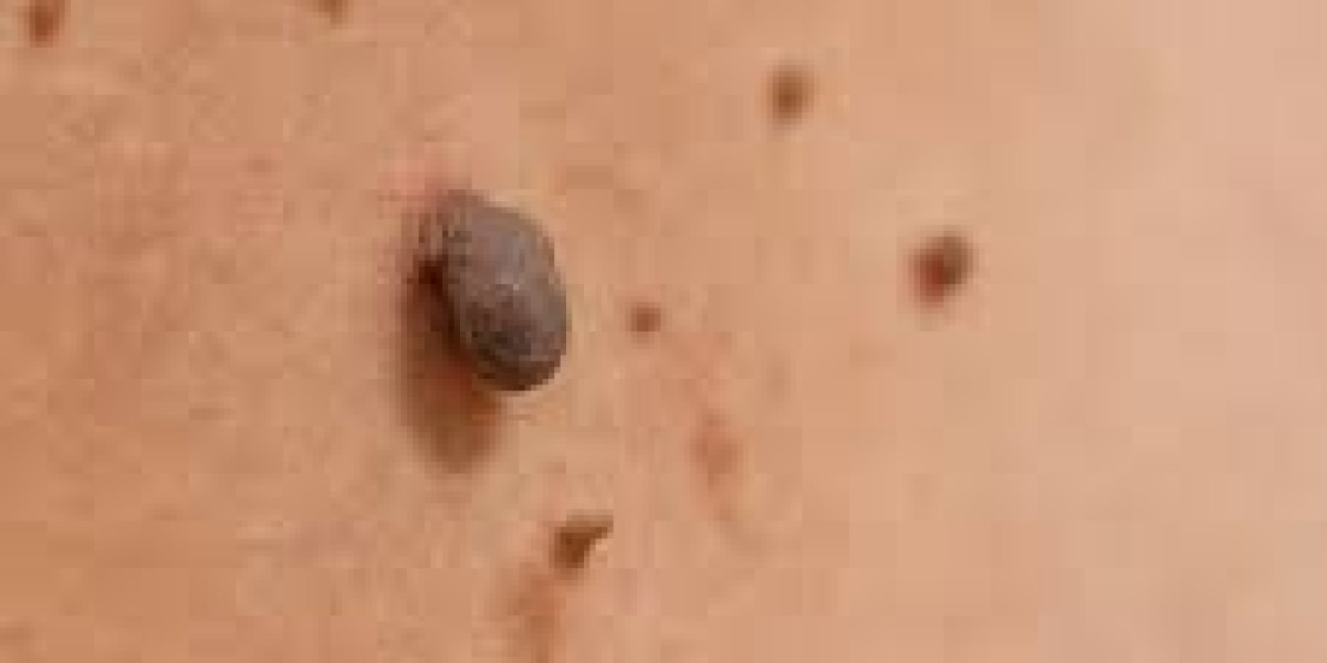 Non-Invasive Mole Removal: A Gentle Approach to Clear, Confident Skin