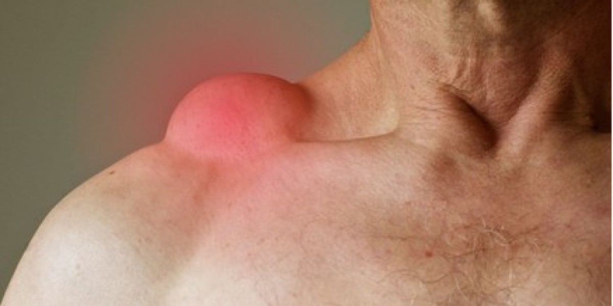 Islamabad’s Most Recommended Lipoma Specialists