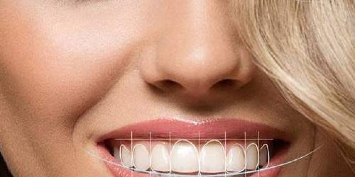 Who Is an Ideal Candidate for Digital Smile Design?