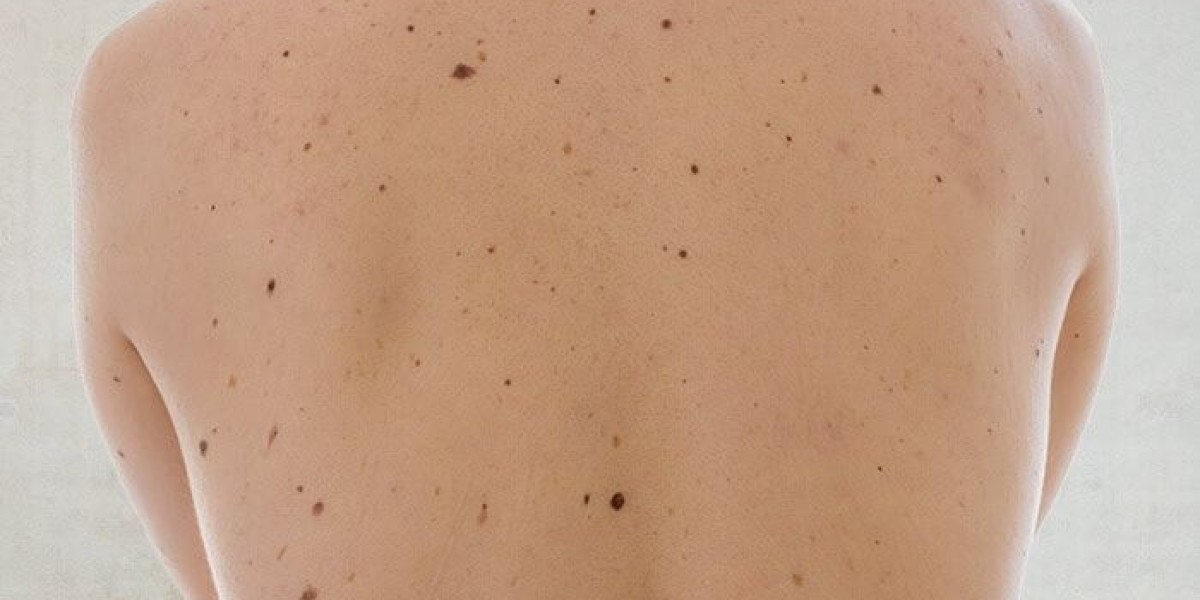 Birthmark Removal in Dubai: Safe, Precise, and Clinically Proven Methods