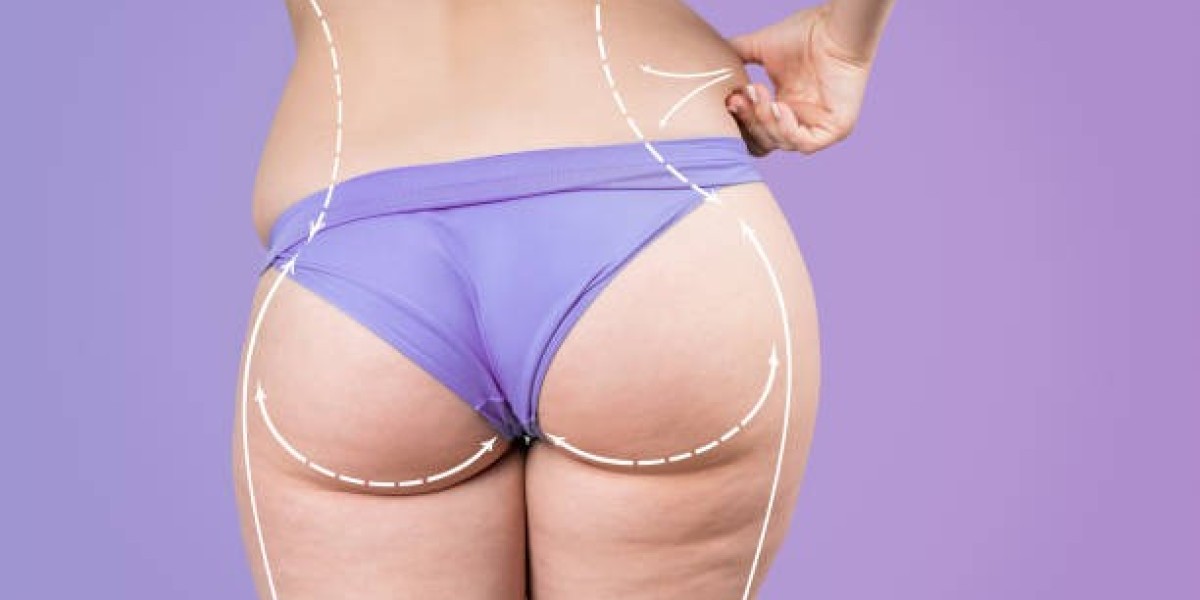 Risks of Liposuction in Riyadh: What Every Potential Patient Should Learn