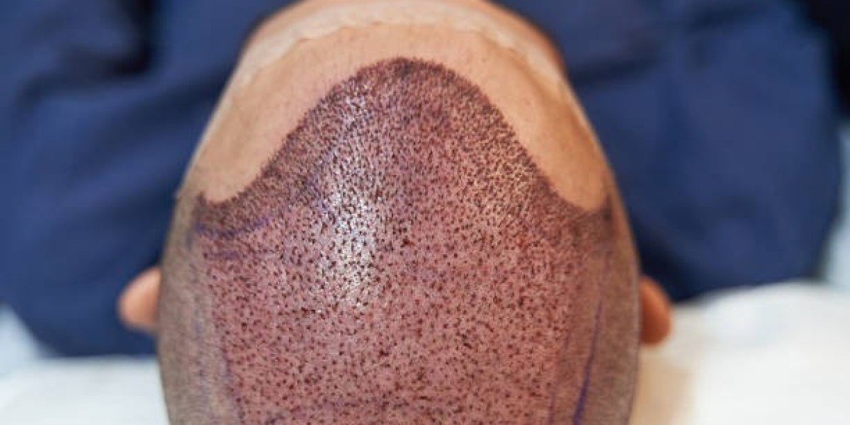 Addressing Common Myths About Hair Restoration