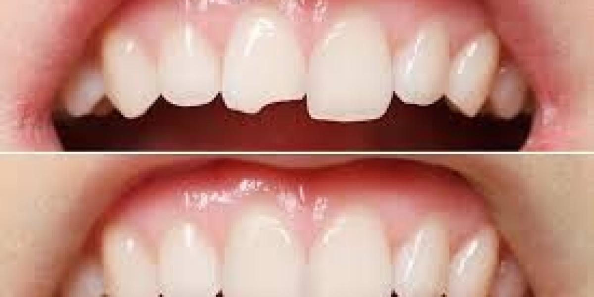 Perfect Your Smile Instantly with Dental Bonding