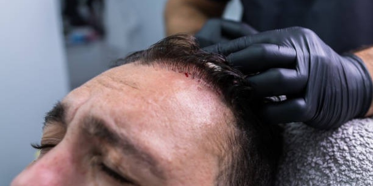 PRP Hair Treatment Science: How Platelets Trigger Follicle Revival