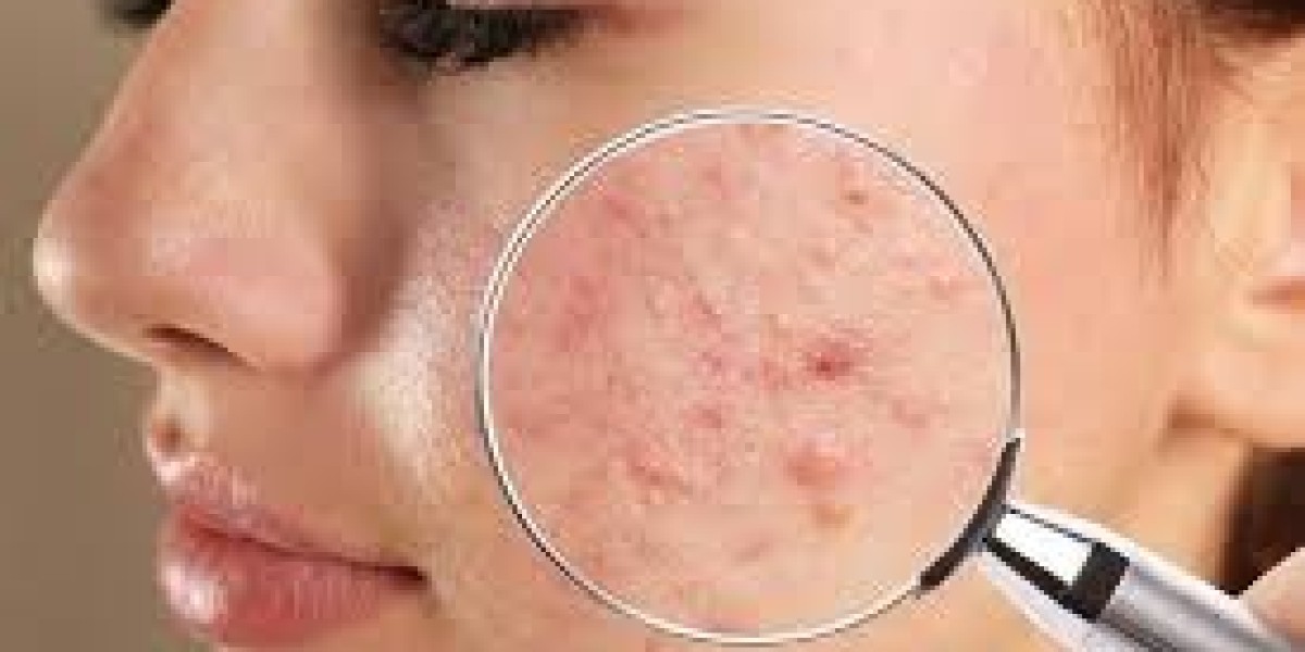 Effective Strategies for Managing Face Acne: Causes, Treatments, and Prevention