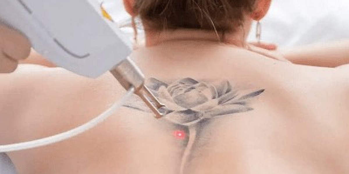 Trusted Tattoo Removal Specialists in Islamabad