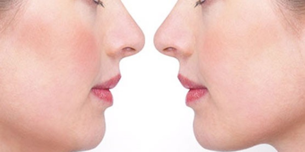 Best Double Chin Removal in Islamabad for a Defined Jawline