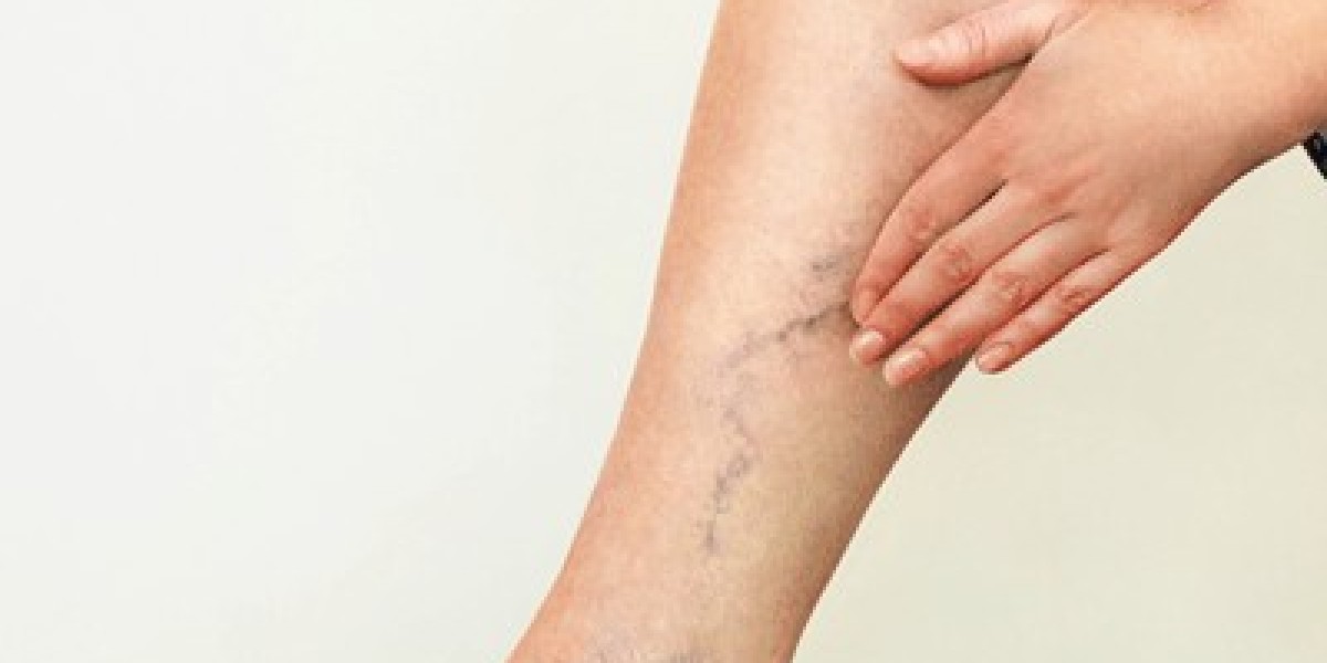 What Are the Advantages of Treating Varicose Veins Early?