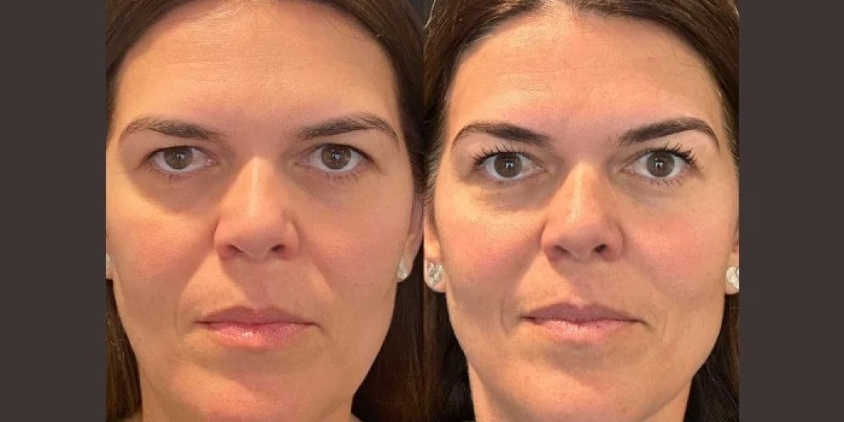 How Age Impacts Results of Thread Lift Treatments in Dubai