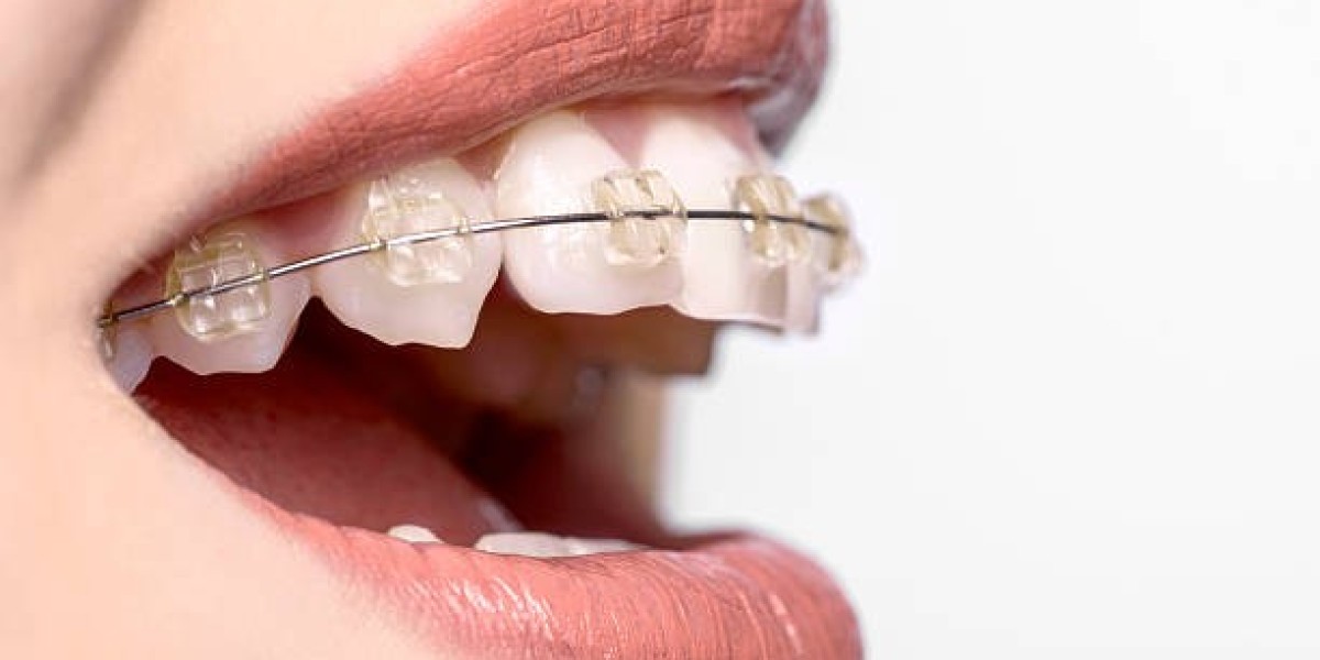 Perfect Your Smile with Teeth Braces in Islamabad