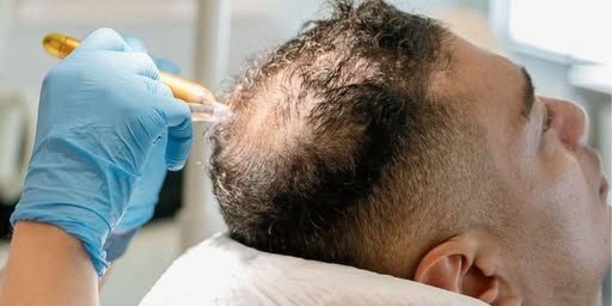 Exosomes Hair Therapy in Dubai: The Future of Non-Surgical Hair Restoration