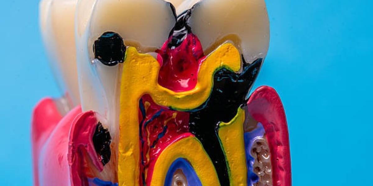 Protect Your Teeth from Infection Root Canal Treatment in Islamabad: