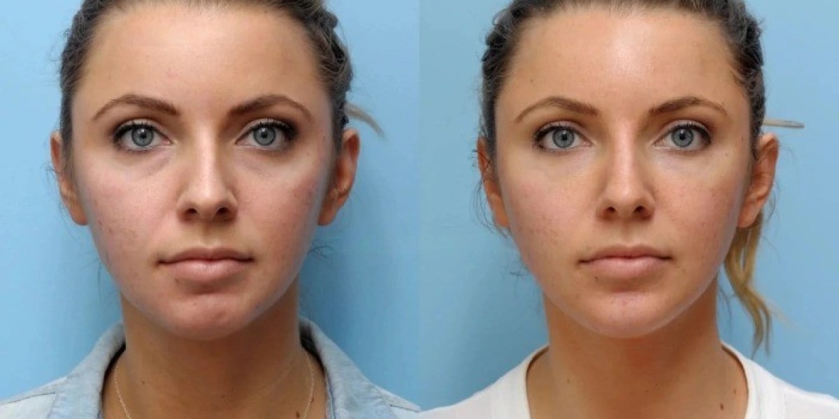 Best Aesthetic Clinic in Dubai Delivering Natural Thread Lift Results