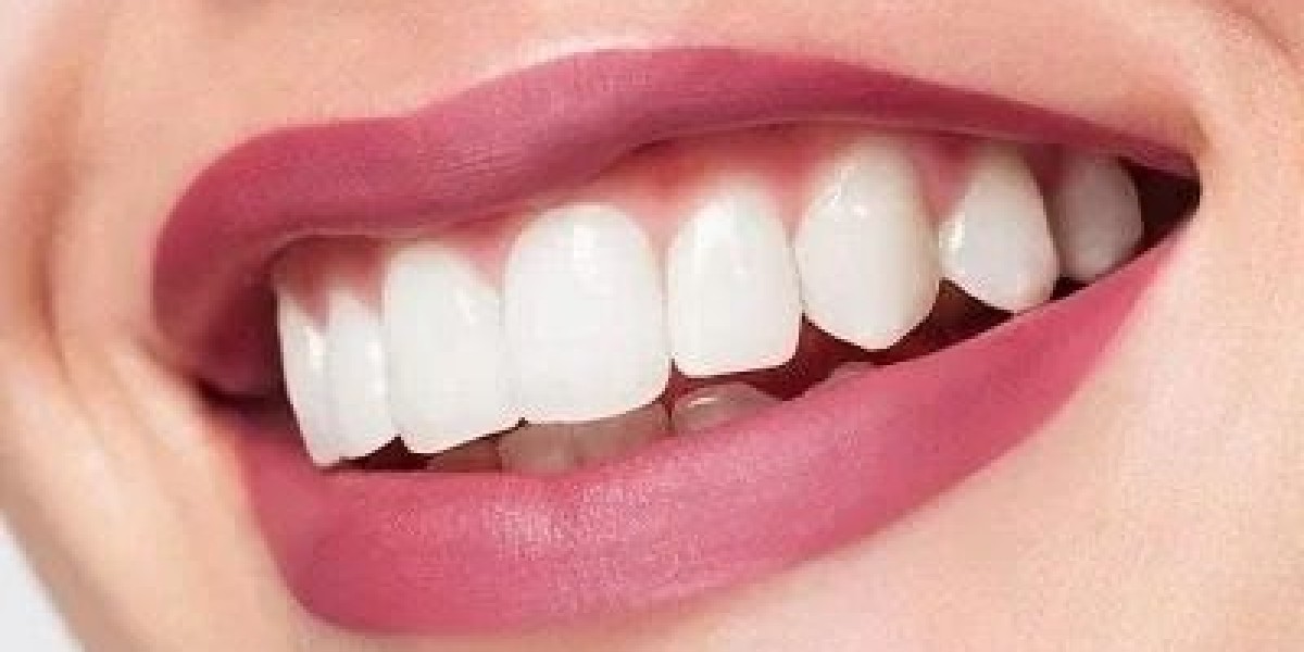 Teeth Whitening in Islamabad Clinics with Free Consultation