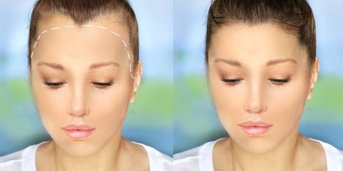 Does Diet Impact Hair Transplant Density in Riyadh?