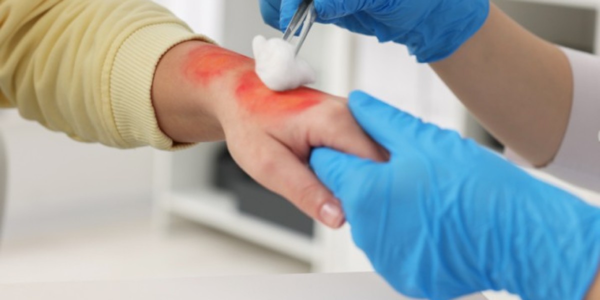 Burn Treatment Services at ER of Fort Worth: Expert Care