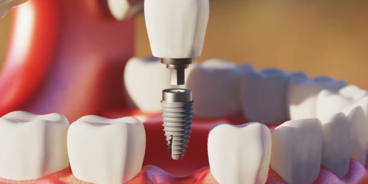 Save Your Tooth and Smile Root Canal Treatment in Islamabad: