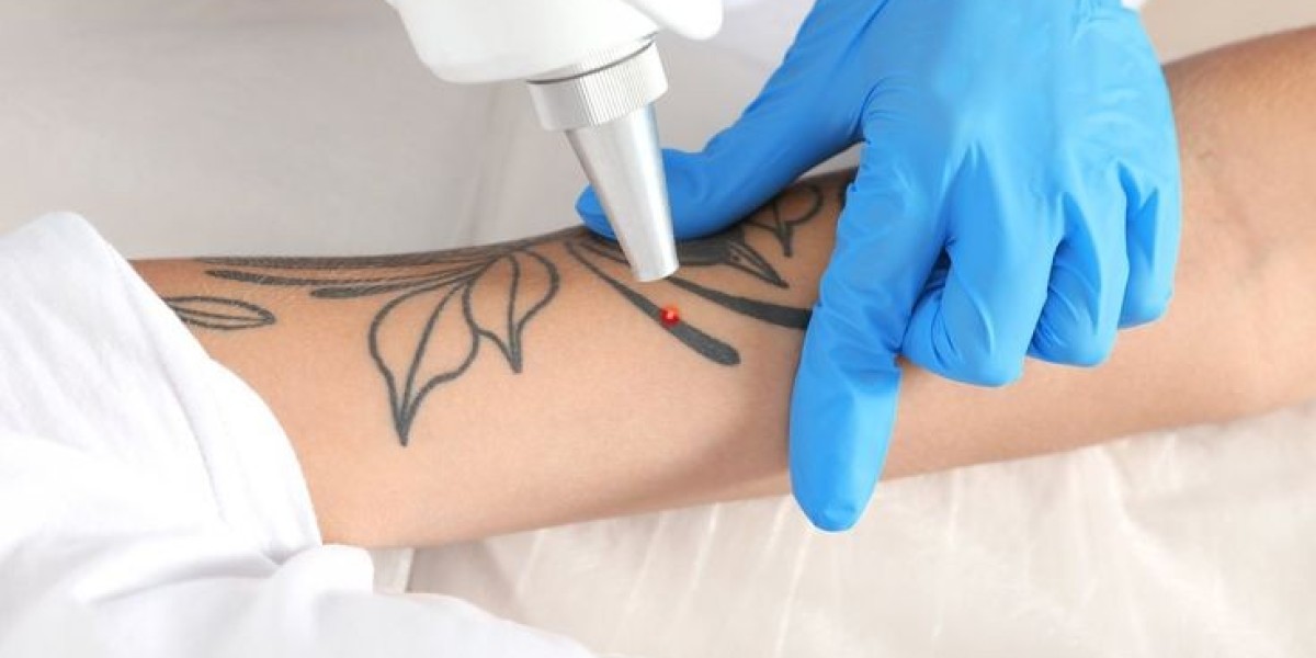 Erasing the Past: The Science of High-Speed Laser Tattoo Removal