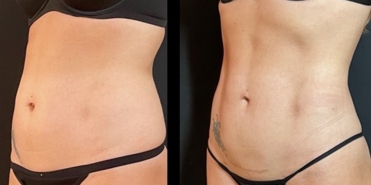 Liposuction for the Stomach: What You Should Know