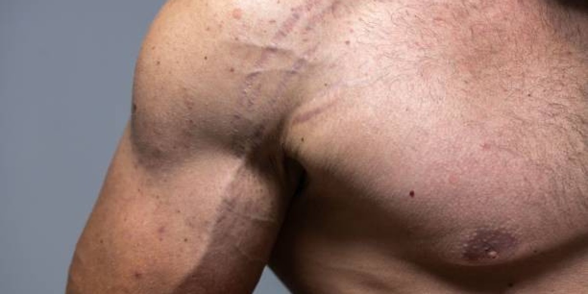 Scar Removal in Dubai: Best for Post-Surgery Scar Fading