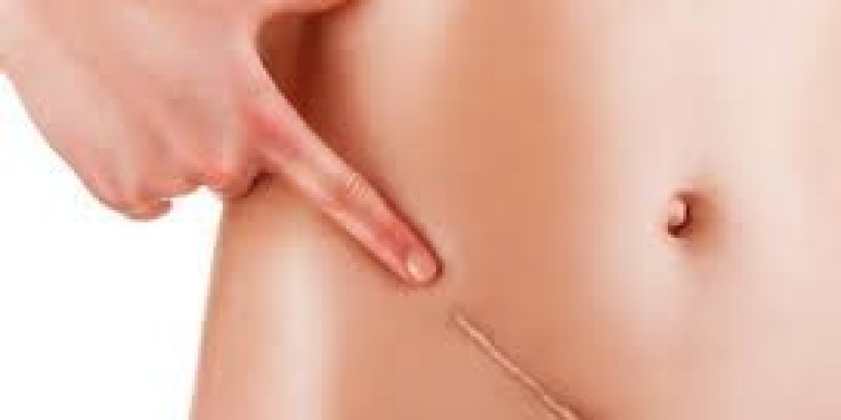 Advanced Keloid Therapy Techniques in Islamabad