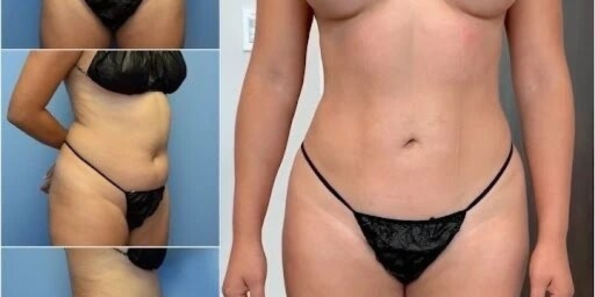 Body Contouring in Dubai: Achieve Natural-Looking Results