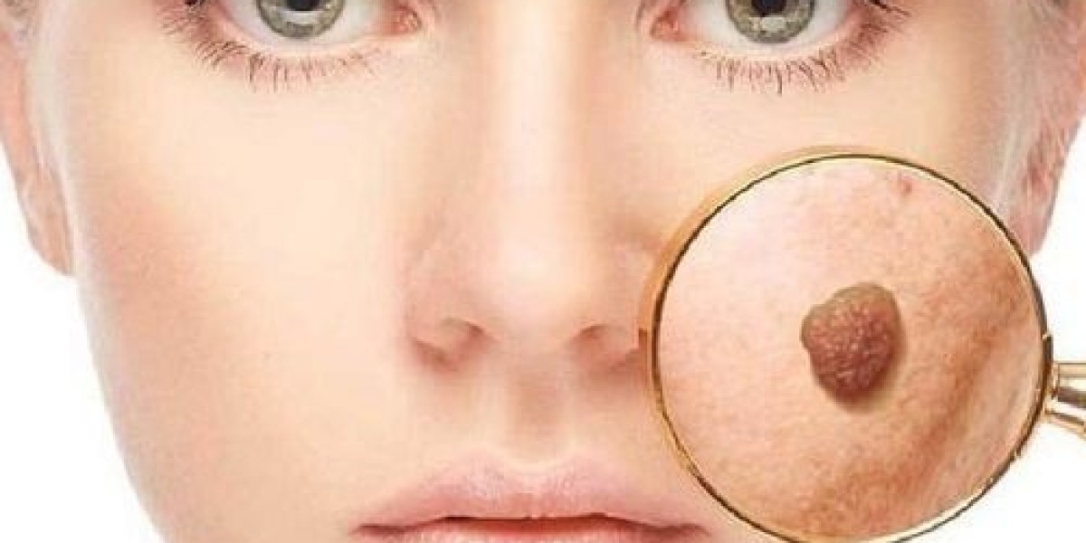 Skin Tag Removal Cost in Islamabad – Complete Price Guide