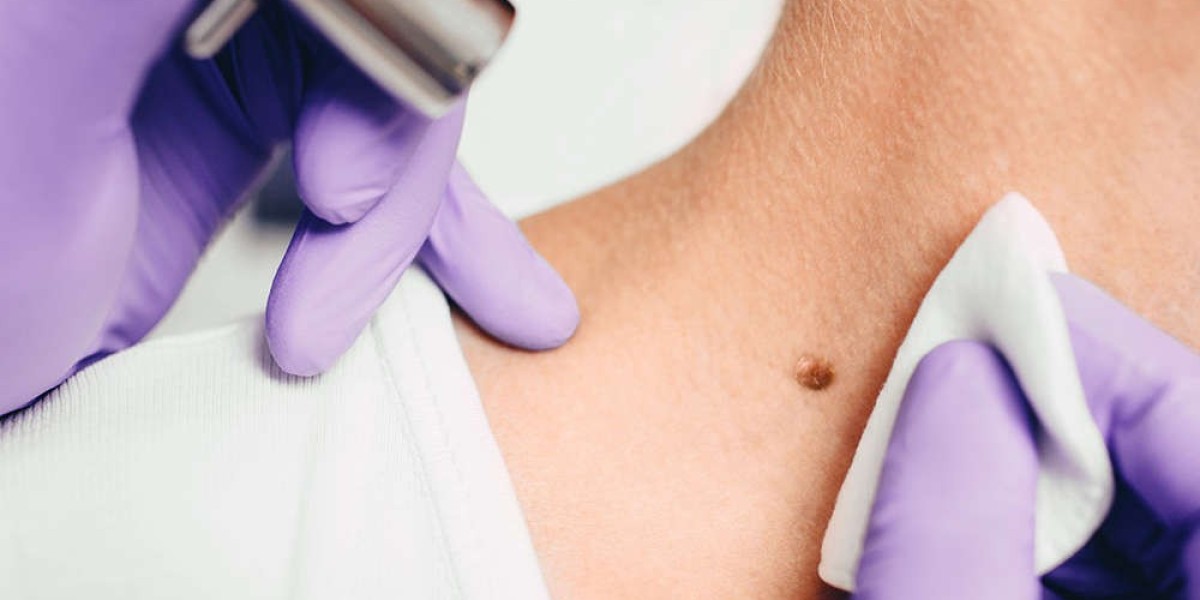 Can Removing Benign Moles Boost Confidence?