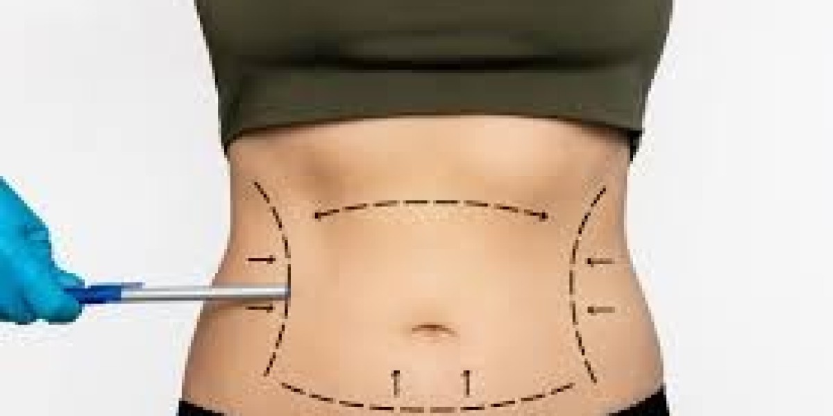 Recovery After Abdominoplasty Dubai: What to Expect