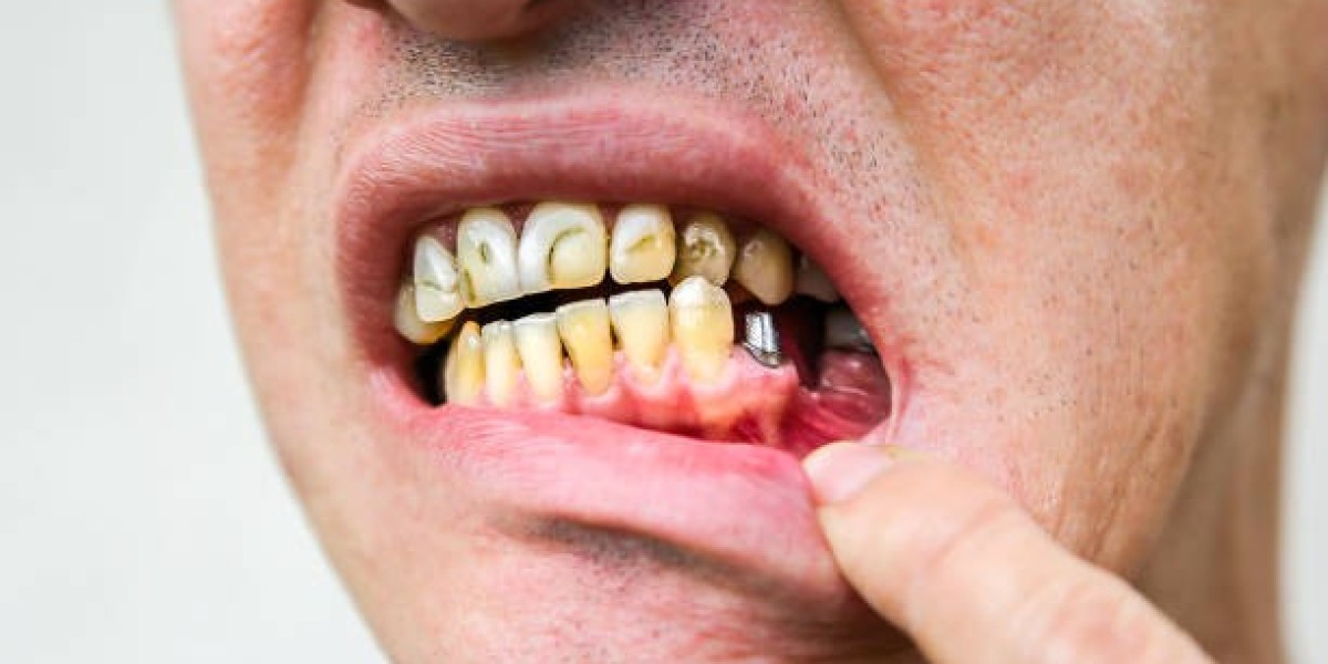 The Complete Guide to Restoring Healthy Gums Gum Grafting in Islamabad: