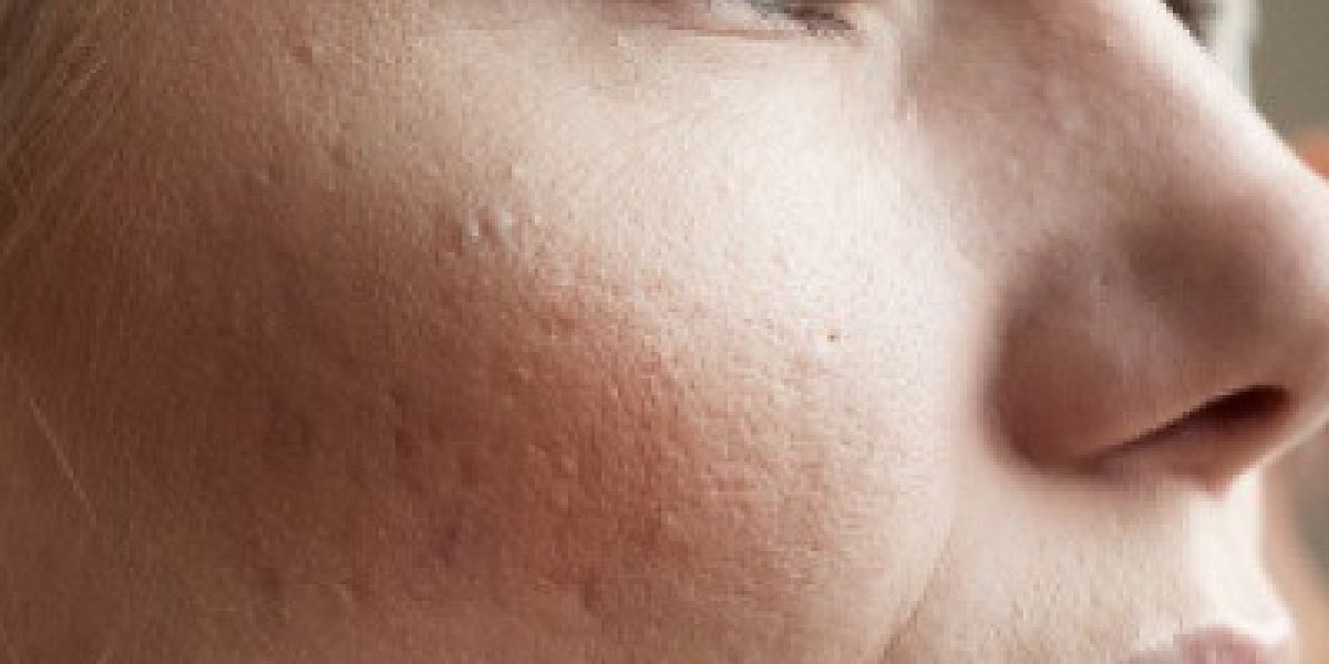 Do Large Pores Improve Once Acne Is Treated?