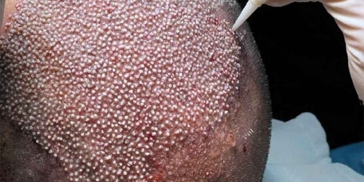 What is the Success Rate of Fue Hair Transplant?