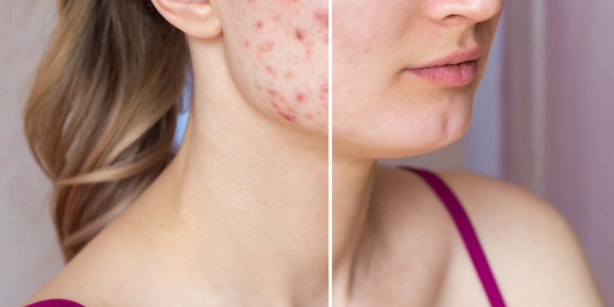 Islamabad’s Leading Acne Scar Treatment Experts