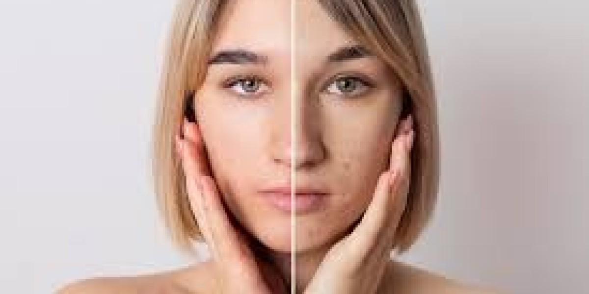 What to Expect During a Skin Pigmentation Treatment Session