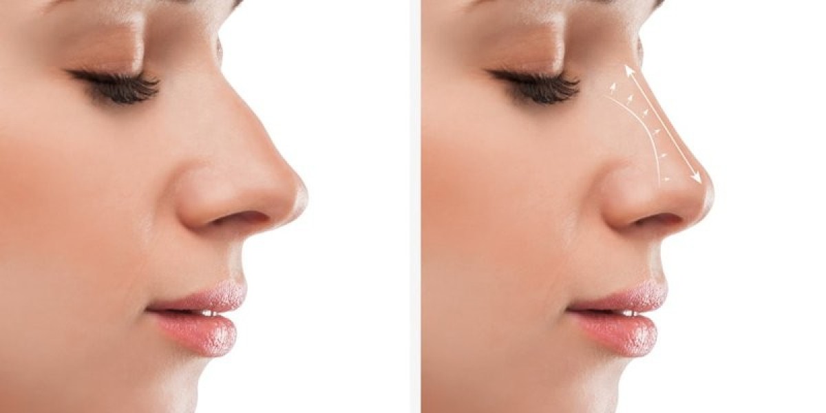 Affordable Rhinoplasty Clinics in Dubai: Your Complete Guide