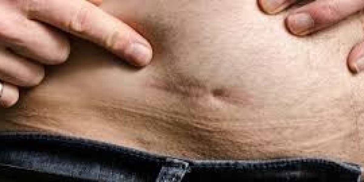 Does Revision Bariatric Surgery Leave Scars?