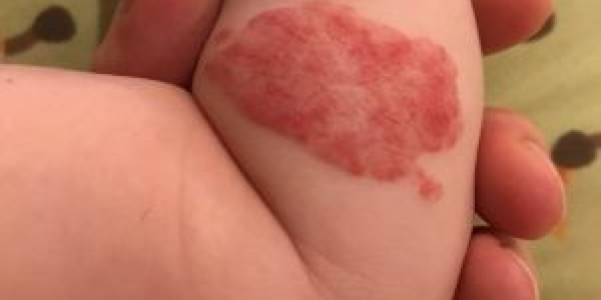 Your Guide to Affordable Birthmark Removal – Feel Confident in Your Skin!