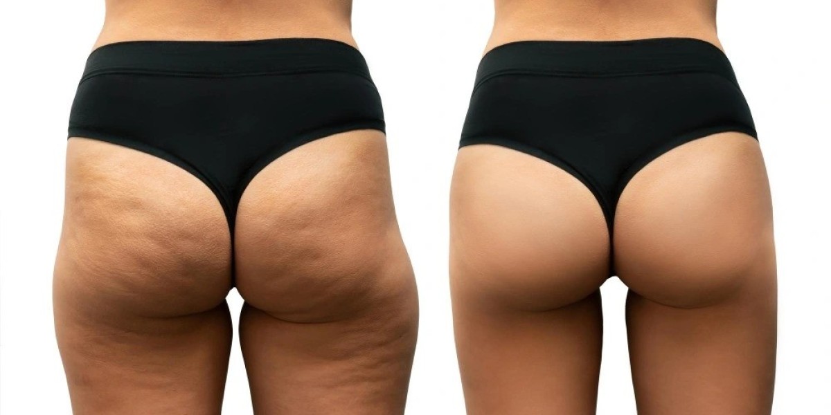 Understanding Body Fillers in Riyadh: What You Should Know