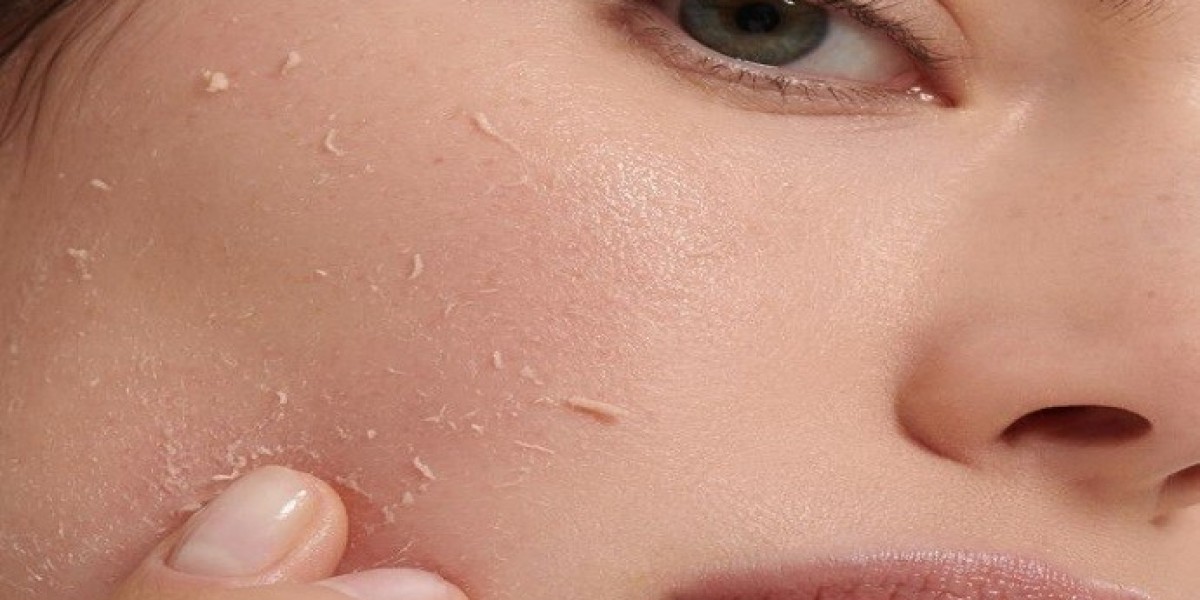 Chemical peels in Dubai: The Final Word on Your Skin Transformation