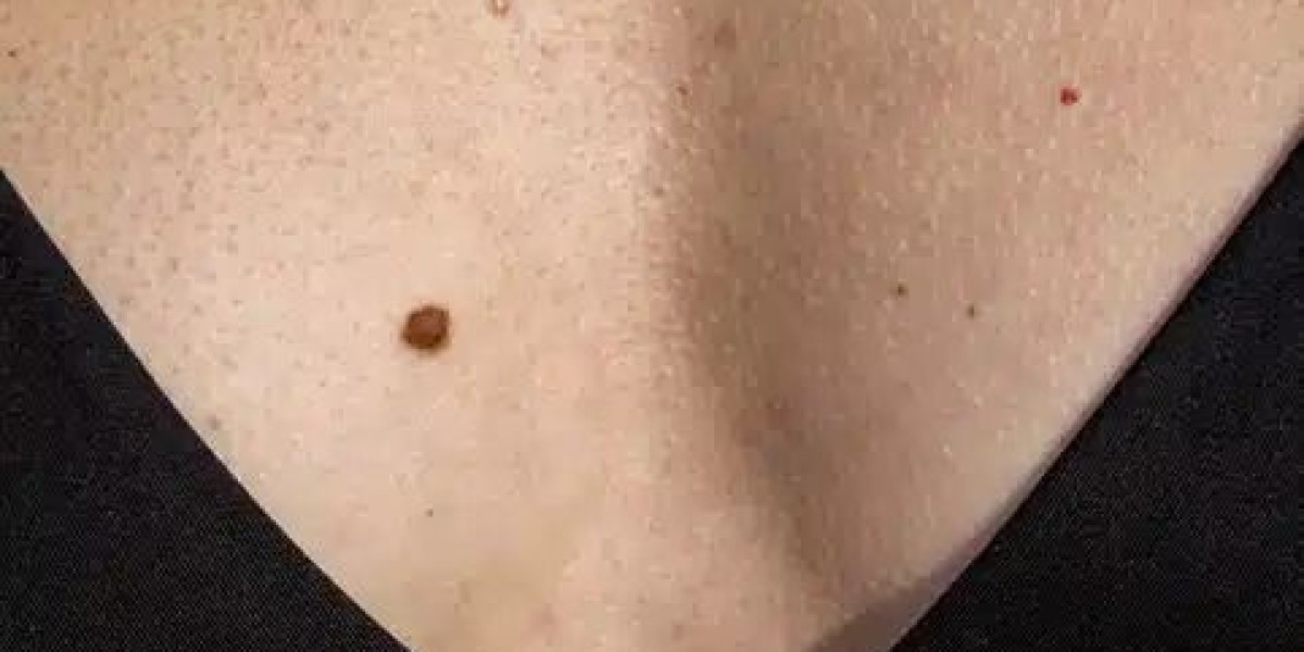 Step-by-Step Process of Mole Removal in Dubai Clinics