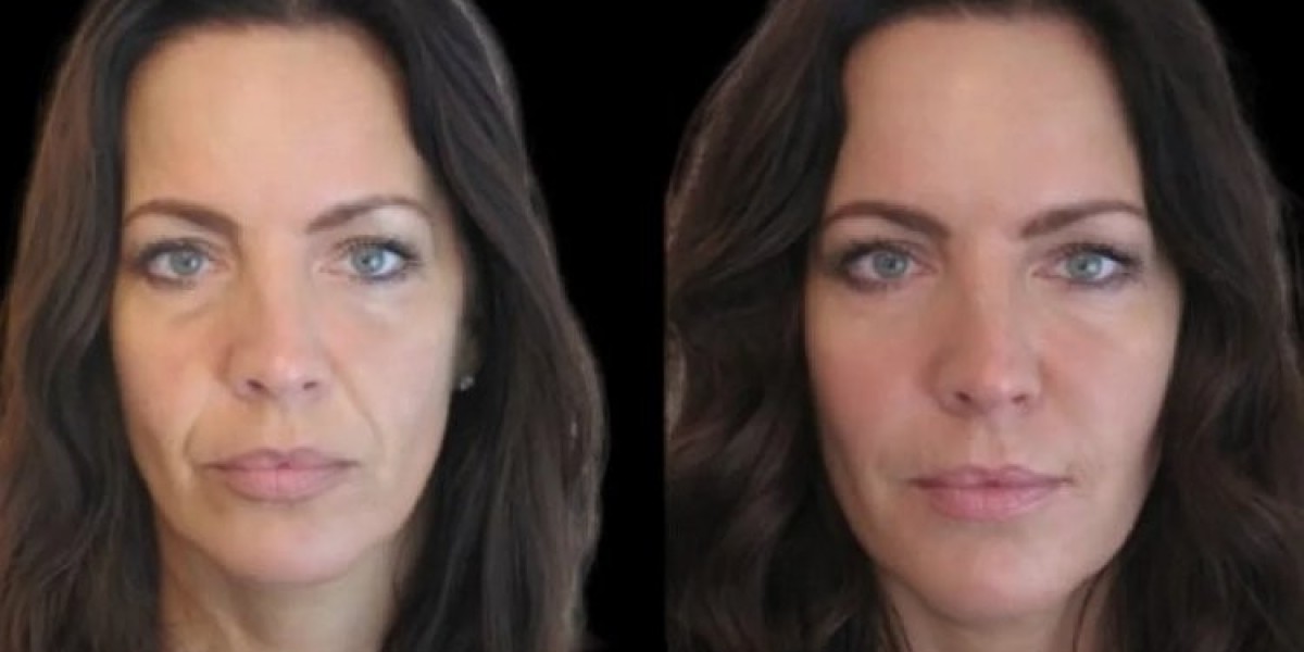Best Aesthetic Clinic in Dubai for Jawline Fillers: Natural Transformations