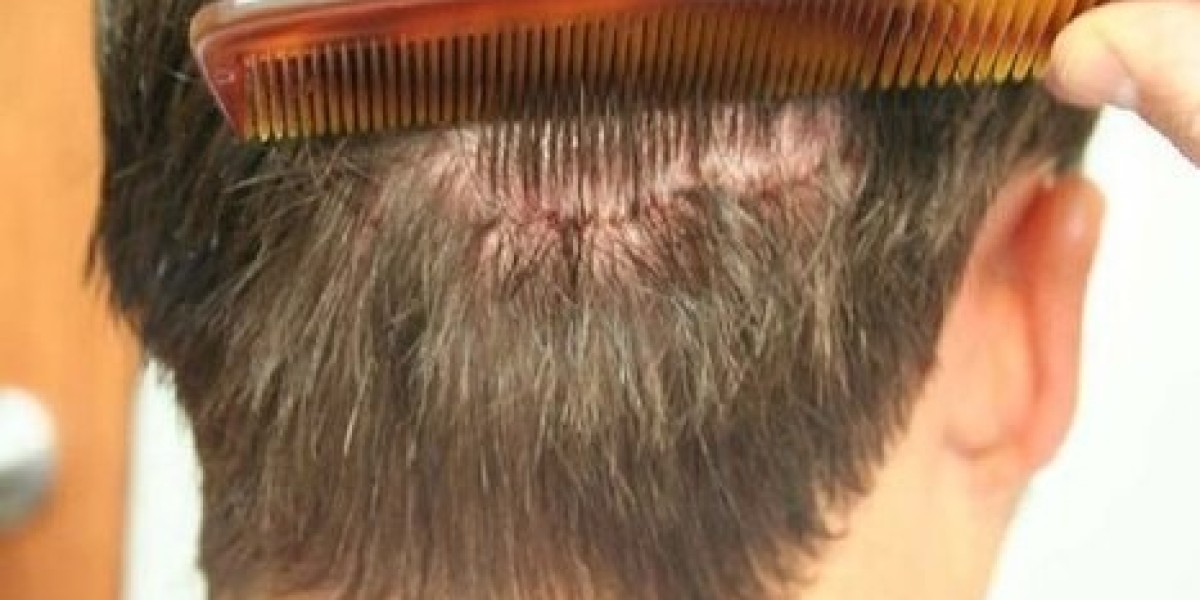 The Ultimate Guide to Hair Restoration in Riyadh: Techniques & Results