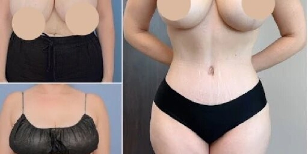 Tummy Tuck in Dubai: Enhance Your Natural Contours