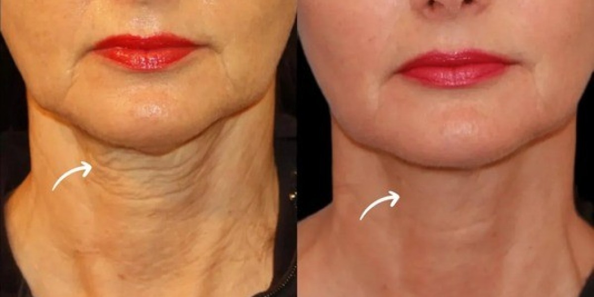 Sculptra Regeneration Plan by Best Doctors in Dubai