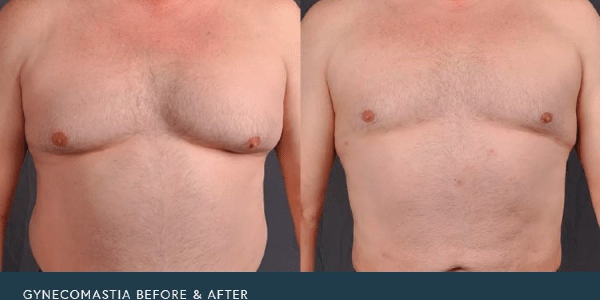 Affordable Gynaecomastia Treatment Dubai: A Complete Guide for Men